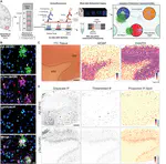 Influence of Alzheimer's Disease Related Neuropathology on Local Microenvironment Gene Expression in the Human Inferior Temporal Cortex